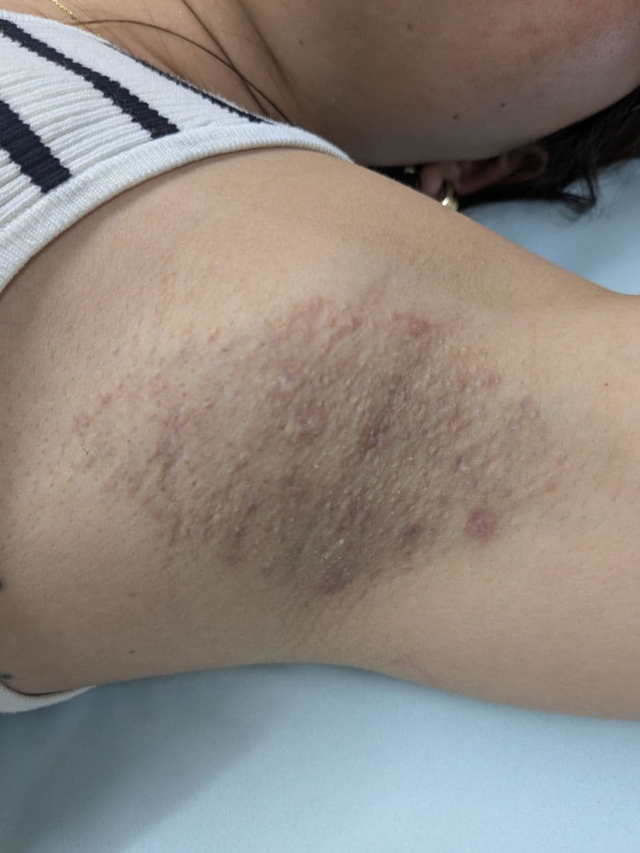 福岡の重度ワキガ治療症例 34歳女性 施術後14日目の左わきの状態