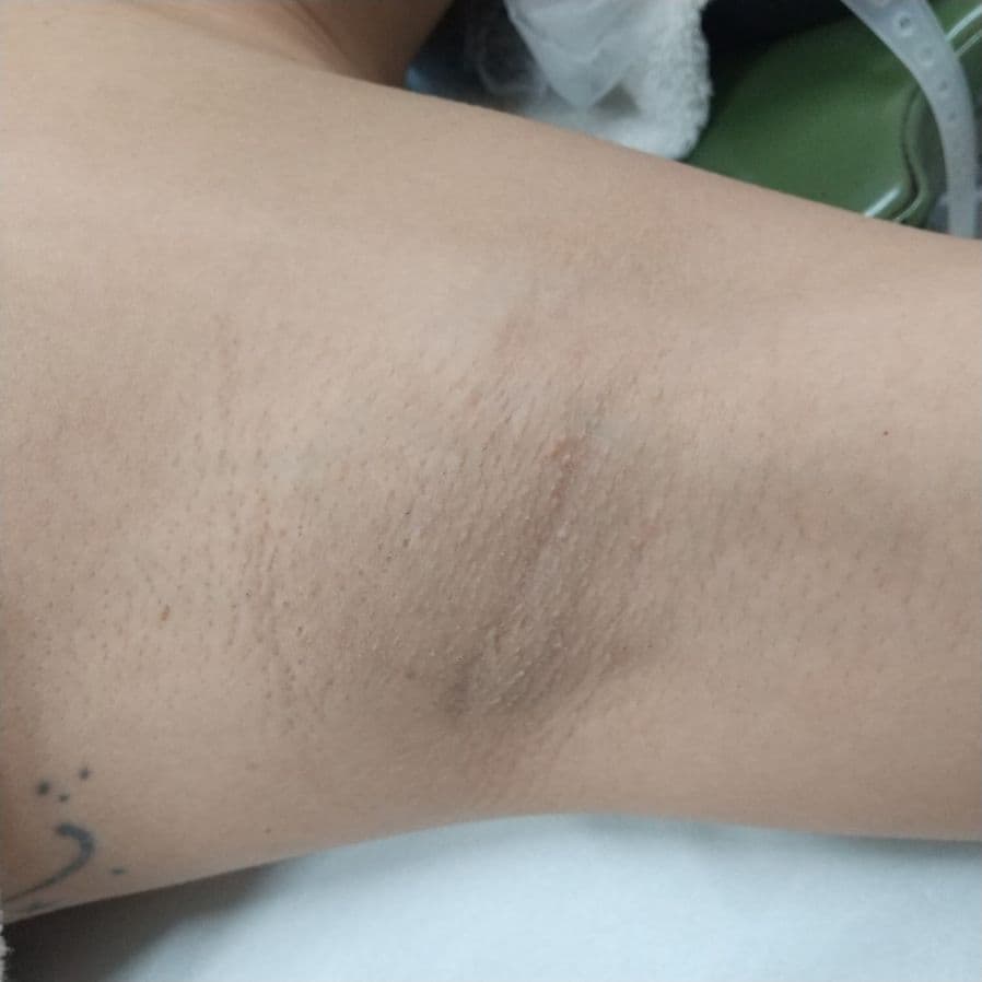 福岡の重度ワキガ治療症例 34歳女性 施術前の左わきの状態