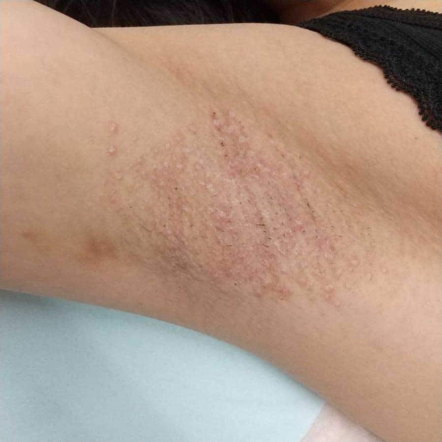 福岡のワキガ治療症例 27歳女性・サービス業 施術後14日目の右わきの状態