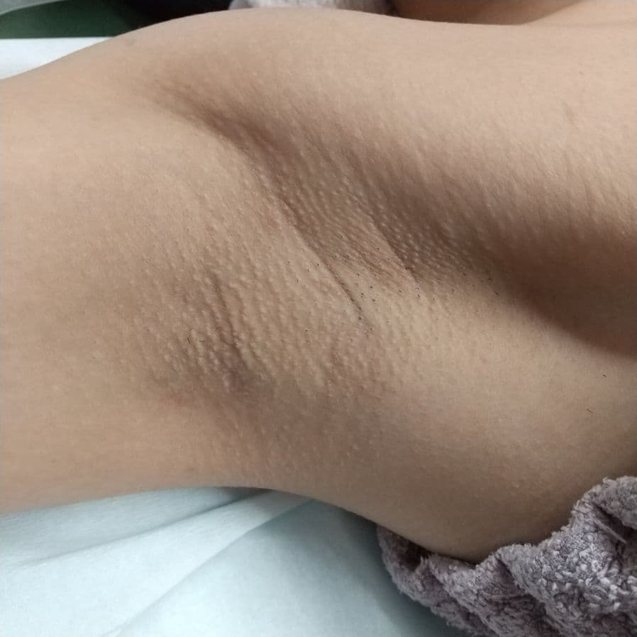 福岡のワキガ治療症例 27歳女性・サービス業 施術前の右わきの状態