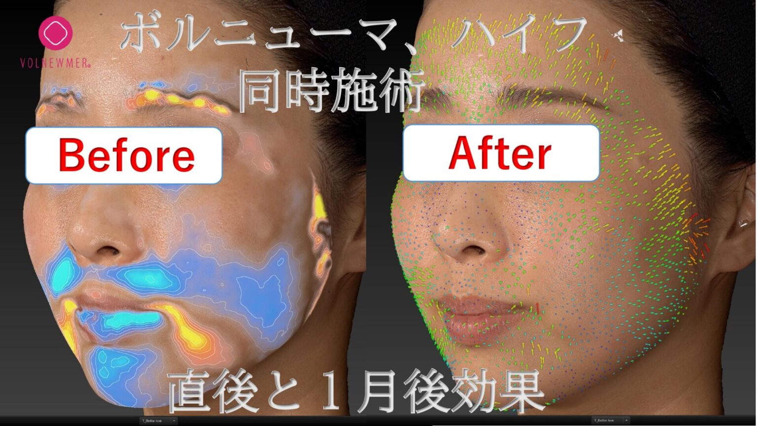 ボルフォーマとは？】ボルニューマ×ハイフ同時施術の効果を徹底解説 
