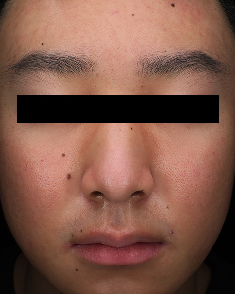 イソトレチノイン（アキュテイン）服用後 5か月 顔の正面