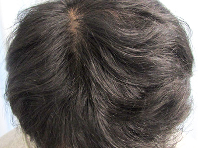 AGA・男性の薄毛治療（前頭部）7か月後