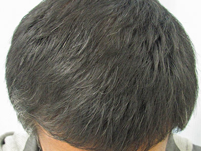 AGA・男性の薄毛治療（前頭部）4か月後