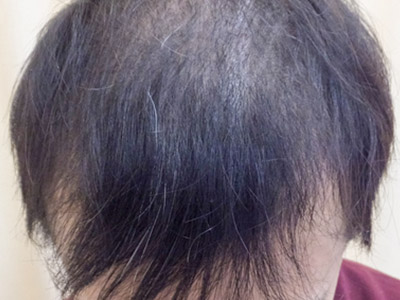 AGA・男性の薄毛治療（前頭部）2か月後
