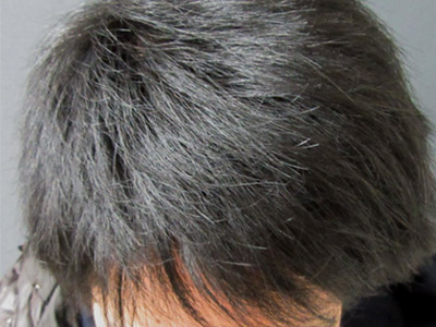 AGA・男性の薄毛治療（前頭部）1年7か月後