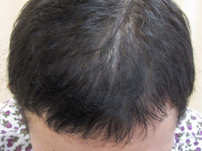 AGA・男性の薄毛治療（前頭部）施術前