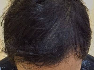 AGA・男性の薄毛治療（前頭部）2か月後