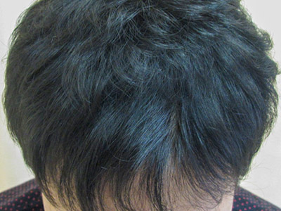 AGA・男性の薄毛治療（前頭部）半年後