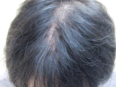 AGA・男性の薄毛治療（前頭部）施術前