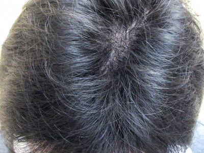 AGA・男性の薄毛治療（前頭部）3か月後