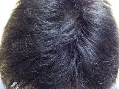 AGA・男性の薄毛治療（前頭部）7か月後