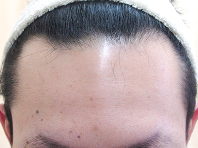 AGA・男性の薄毛治療（生え際）半年後