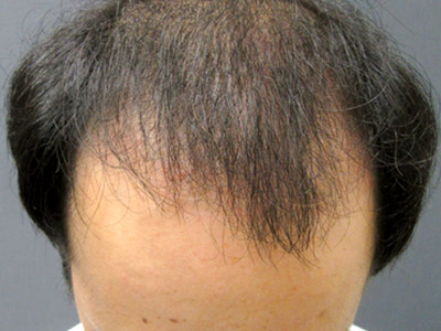 AGA・男性の薄毛治療（生え際・前頭部）3か月後