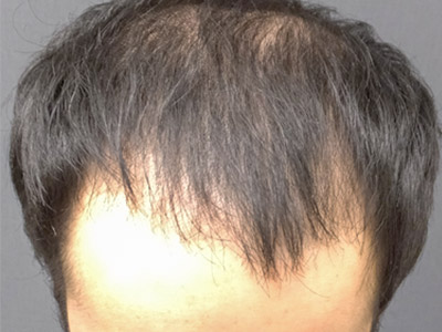 AGA・男性の薄毛治療（生え際・前頭部）10か月後