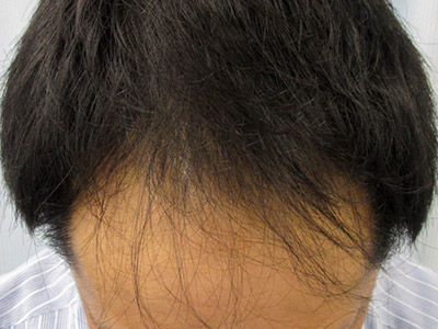 AGA・男性の薄毛治療（生え際・前頭部）9か月後