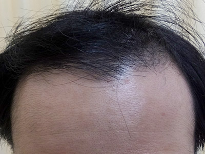 AGA・男性の薄毛治療（生え際・前頭部）4か月後