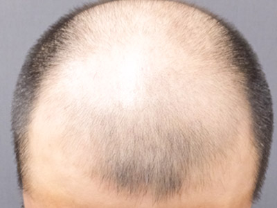 AGA・男性の薄毛治療（生え際・前頭部）施術前