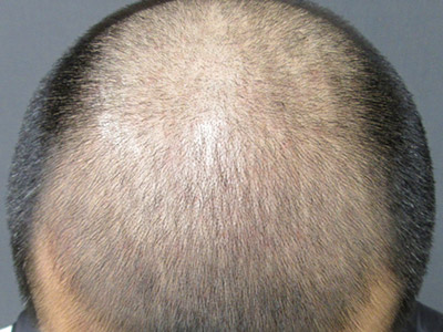 AGA・男性の薄毛治療（生え際・前頭部）半年後