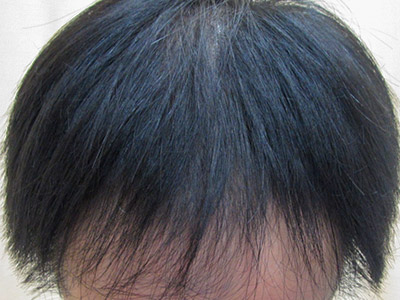 AGA・男性の薄毛治療（生え際・前頭部）施術前