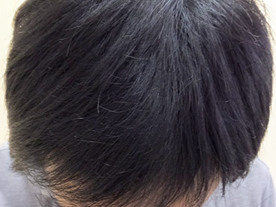 AGA・男性の薄毛治療（生え際・前頭部）5か月後
