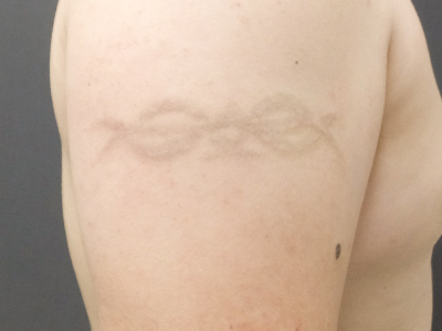 タトゥー・刺青除去（ピコレーザー+Qスイッチヤグレーザー）4回施術後