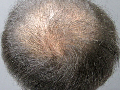 AGA・男性の薄毛治療（頭頂部）3か月後