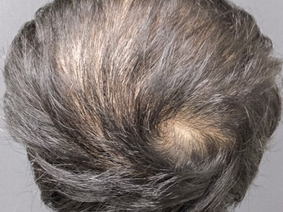 AGA・男性の薄毛治療（頭頂部）10か月後
