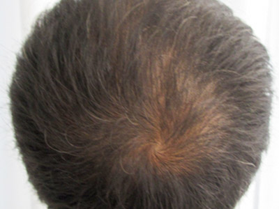 AGA・男性の薄毛治療（頭頂部）1か月後