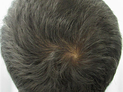 AGA・男性の薄毛治療（頭頂部）4か月後