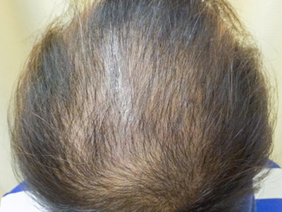 AGA・男性の薄毛治療（頭頂部）施術前