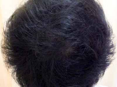 AGA・男性の薄毛治療（頭頂部）5か月後