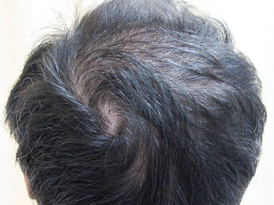 AGA・男性の薄毛治療（頭頂部）1年後