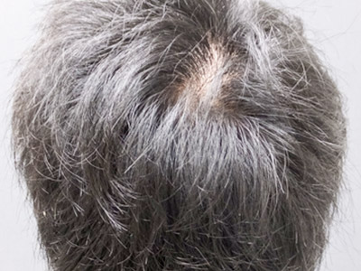 AGA・男性の薄毛治療（頭頂部）1年1か月後