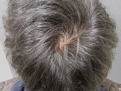 AGA・男性の薄毛治療（頭頂部）1年7か月後
