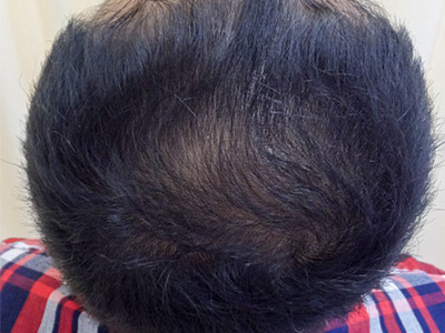 AGA・男性の薄毛治療（頭頂部）7か月後