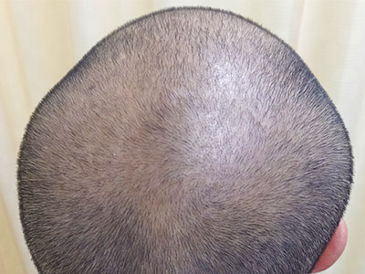 AGA・男性の薄毛治療（頭頂部）3か月後