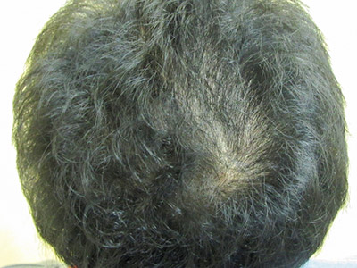 AGA・男性の薄毛治療（頭頂部）1年後
