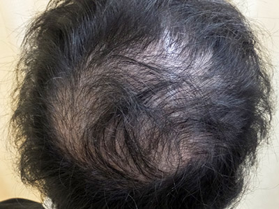 AGA・男性の薄毛治療（頭頂部）施術前