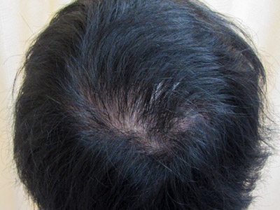 AGA・男性の薄毛治療（頭頂部）7か月後
