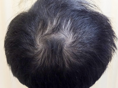 AGA・男性の薄毛治療（頭頂部）2か月後
