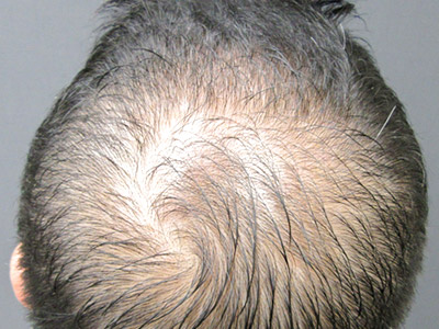 AGA・男性の薄毛治療（頭頂部）4か月後