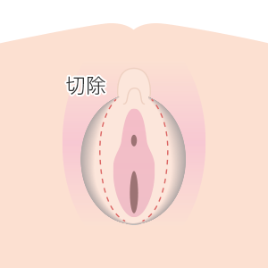 小陰唇縮小術の切除部分