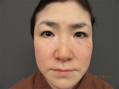 ヒアルロン酸注入（目の下・頬・ほうれい線 各1本）40代女性 施術後