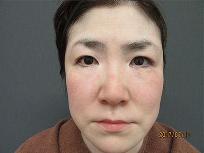 ヒアルロン酸注入（目の下・頬・ほうれい線 各1本）40代女性 施術前