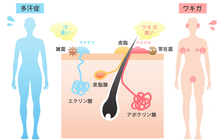 ワキガと多汗症は原因となる汗腺が異なる