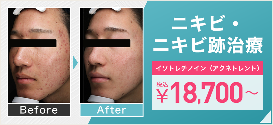 ニキビ・ニキビ跡治療