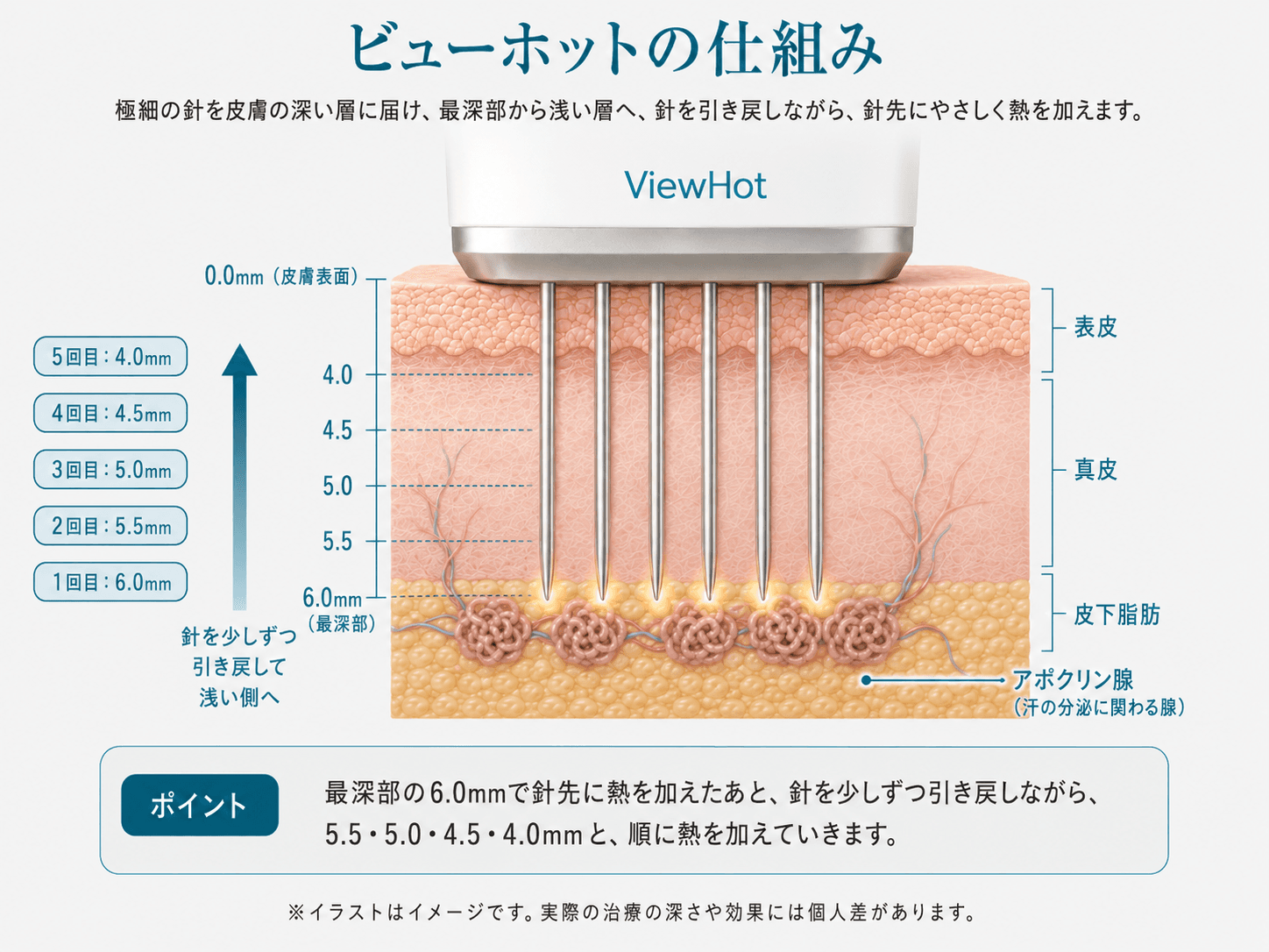 ビューホットの仕組みを示すイラスト。極細の針を皮膚の深い層に刺し、針を引き戻しながら各深さ(4.0〜6.0mm)でアポクリン汗腺に高周波の熱を加える様子を表した図。